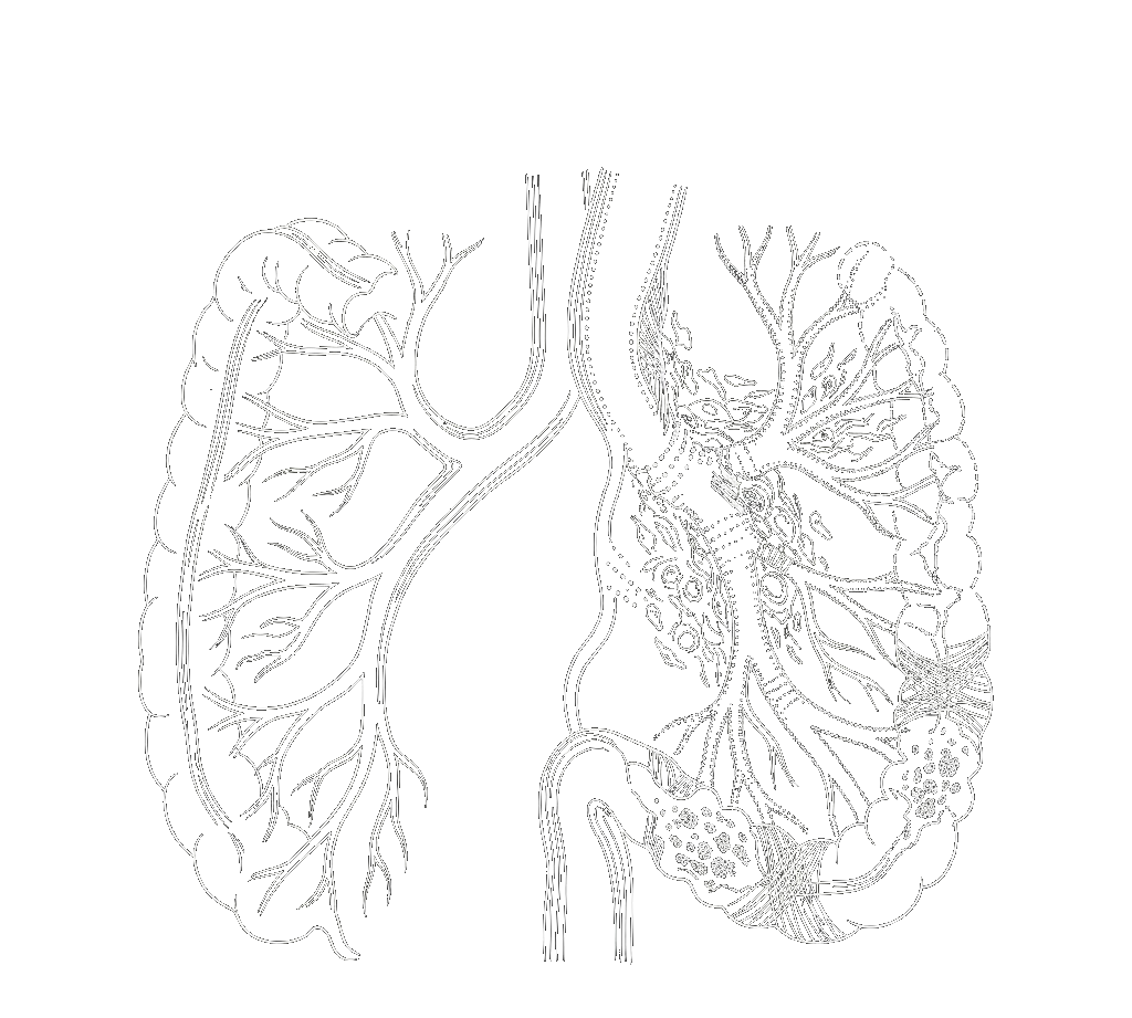 Radiation-Induced GI Damage